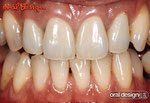 2 . 術後：装着されたメタルセラミックスクラウンの４前歯。以前装着していたオールセラミックスよりも自然感のある補綴物。歯肉、歯頸部の審美が改善され、患者の満足が得られたケース。。