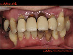 前歯部の前突、二次カリエスによる歯頸部の黒ずみ、歯槽膿漏、等による来院。初診時の正面観の口腔内写真。