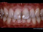 中切歯2本のカリエス（虫歯）による審美障害が理由で来院。正中線も右側に曲がっている。