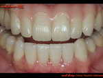 Case-10-1（下顎）と一緒に撮影された、審美的に改善された上下顎の口腔内。