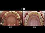 インプラント-メタルセラミックスにより審美的に改善された上顎の口腔内。