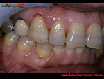 ジルコニア（ポーセレン築盛）オールセラミックスクラウンを口腔内に試適し、歯科医師、患者両方から了解を得られた状態の写真。