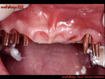 テンポラリークラウン（仮歯）を、外した状態の口腔内。