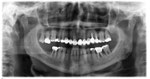 Situation initiale: perte des deux molaires en bas à droite de l'image, avec 5mm d'os sain dessous...