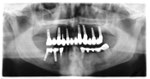 Autre cas d'implants multiples