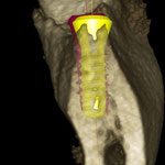3 dimensionales CT - Querschnitt gelbes Implantat