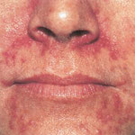 Periorale Dermatitis