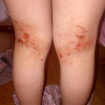 reconnaitre l eczema atopique eczema a vif des plis des genoux