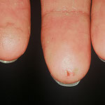 eczema allergique a l ail