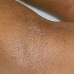dermatite atopique sur peau pigmentée