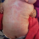 photo d'un dos de bébé recouvert d'un eczéma sévère