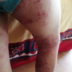 jambe d'un enfant avec eczéma surinfecté