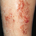 eczema allergique protege tibia