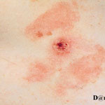 eczema allergique a la collophane