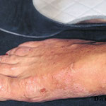 eczema allergique chrome des chaussures