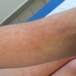 Eczéma sévère d'un bras