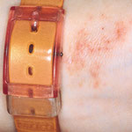 eczema allergique nickel bracelet de montre