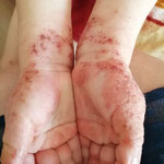 eczema des poignets surinfectes