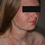 eczéma sévère du visage ed'une jeune fille dans le cadre de la dermatite de la tête et du cou 