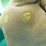 Callo Plantar