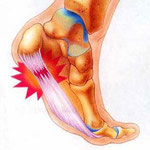 Fascitis Plantar