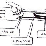 Bild 3. Shuntanlage mit Verbindung des Arterien-/ und Venenverlaufes.