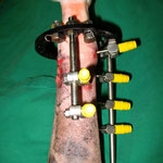 Umstellungsosteotomie mittels Ringfixateur 