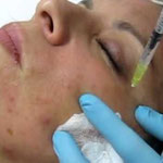 Mesoterapia Facial para Acné