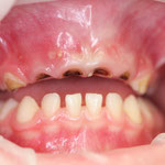 (BILD2) Zerstörte Zähne im Oberkiefer (Front) durch "Dauernuckeln" an Flaschen! -> Nursing-Bottle-Syndrom
