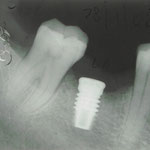 Impianto al posto del molare inferiore destro