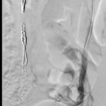 Figure 1: Left ovarian vein reflux post right ovarian vein embo