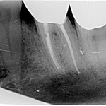 Wurzelkanalbehandlung Fall 3