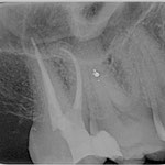 Wurzelkanalbehandlung Fall 5
