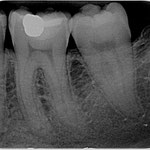 Wurzelkanalbehandlung Fall 2