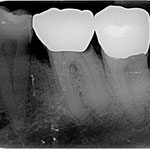 Wurzelkanalbehandlung Fall 3