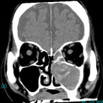 CT 右に比べて左側の白い骨が厚くなっています