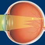 Occhio astigmatico