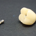 Corona sobre implante