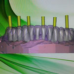 Diseño de estructuras CAD-CAM