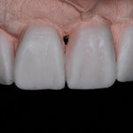 Vervollständigung der Zahnform am Modell ("Wax up")