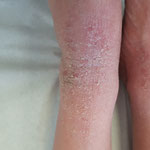 Eczéma généralisé sous forme erythrodermie
