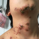 eczema du cou surinfecte