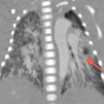 Coupe coronale de scanner en fenetre parenchymateuse: hypervascularisation bilatérale avec atéléctasie partielle gauche secondaire à la compression bronchique gauche par l'APG dilatée.