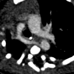 Hypoplasie de l'arche aortique avec crosse droite