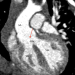 Scanner préopératoire montrant l'aorte à cheval au dessus de la CIV infundibulaire