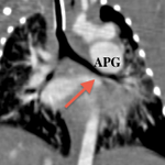 Coupe coronale de scanner: Noter le compression de la bronche souche gauche par l'APG dilatée