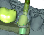 トーシンデンタル　ジルコンザーン　CAD/CAM　ソフトウェア