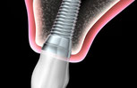 Wie werden Implantate gesetzt? (© psdesign1 - Fotolia.de)