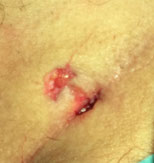 wound after pit picking for pilonidal cyst