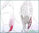 母趾外転筋が原因で外反母趾